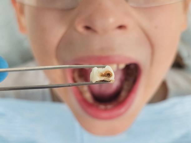 Best Chipped Tooth Repair Near Me  in Windsor, MO